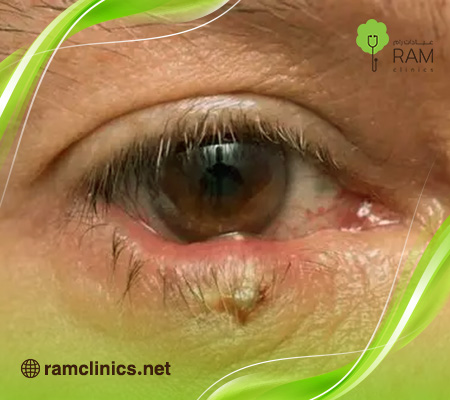 جفن-العين-الأبيض