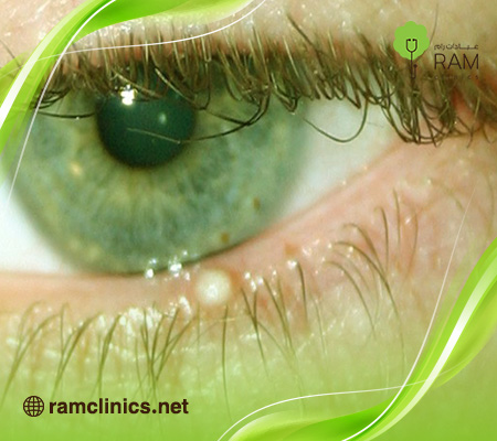 جفن-العين-الأبيض