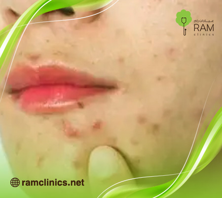 انتشار-حبوب-في-الجسم