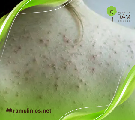 سبب-ظهور-حبوب-ذات-رؤوس-بيضاء-في-الجسم