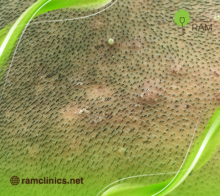 حبوب-في-الرأس-مؤلمة