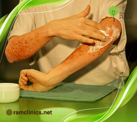 ماهو-علاج-الحروق