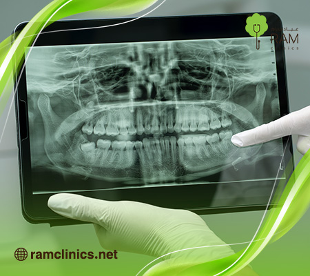 اشعة-بانوراما-اسنان