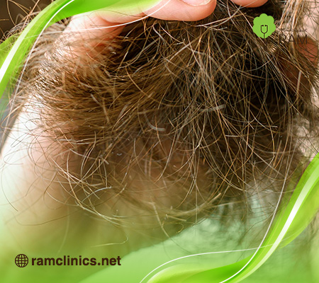 علاج-الشعر-المحروق