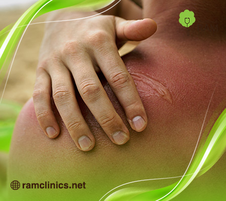 ماسك-لحروق-الشمس