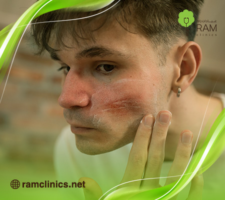 ماسك-لحروق-الشمس