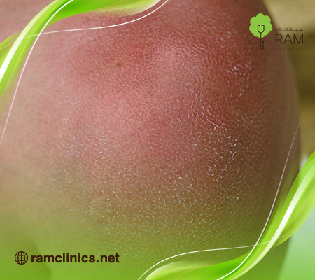 ماسك-لحروق-الشمس