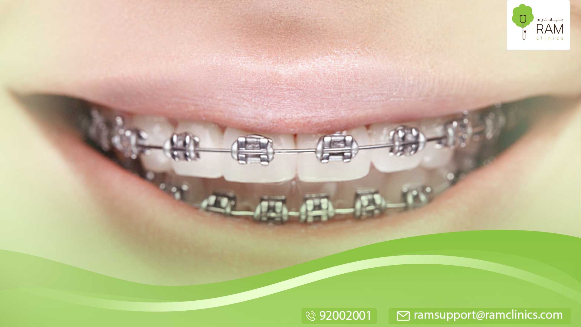 اهم المعلومات عن تقويم الأسنان