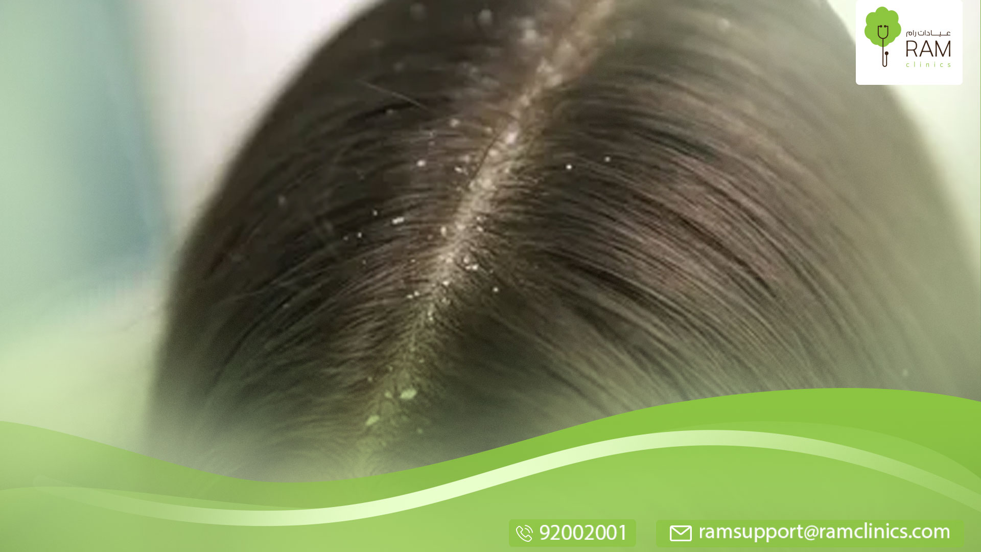 اسباب ظهور قشرة الشعر