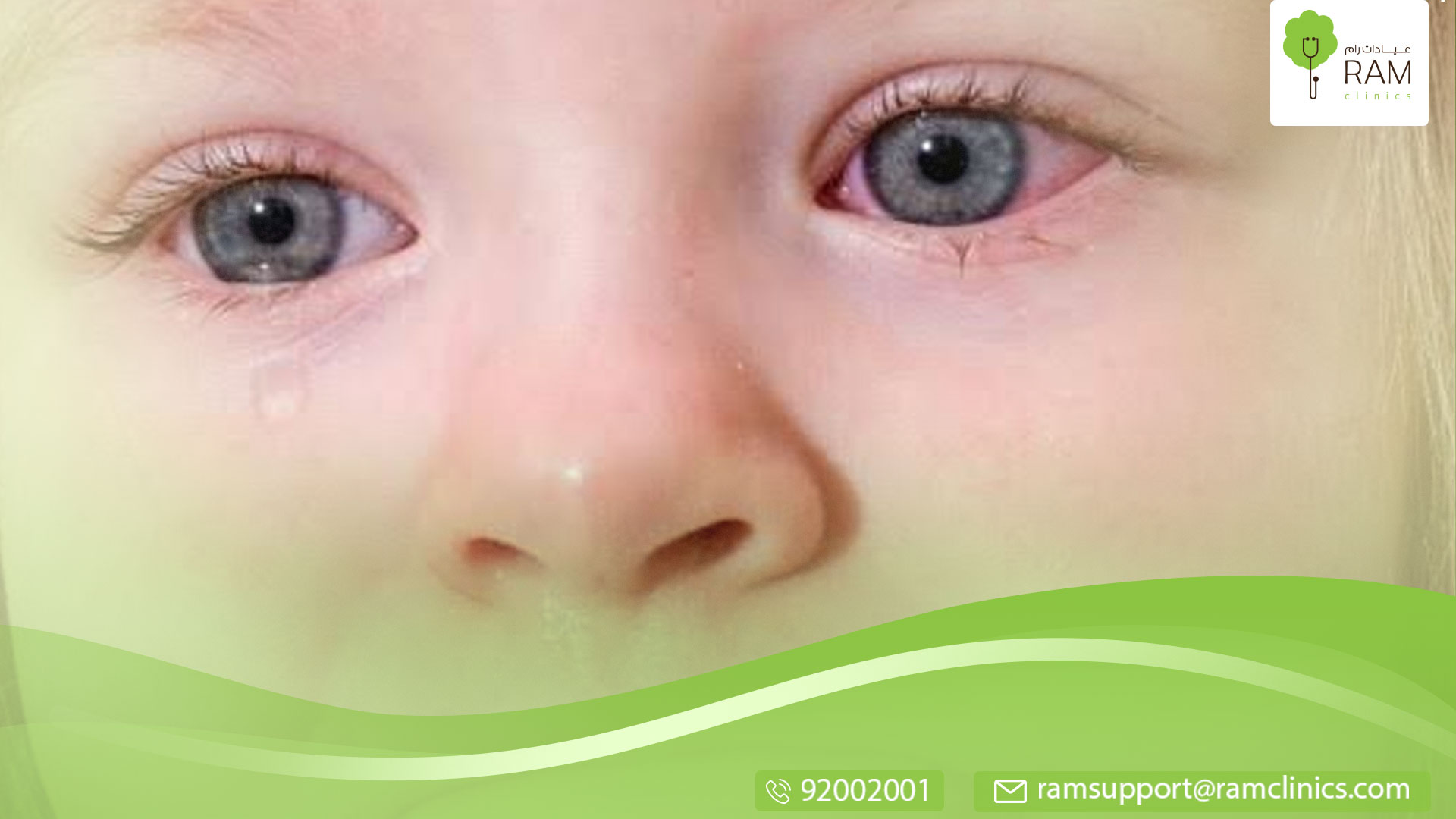 احمرار العيون عند الأطفال