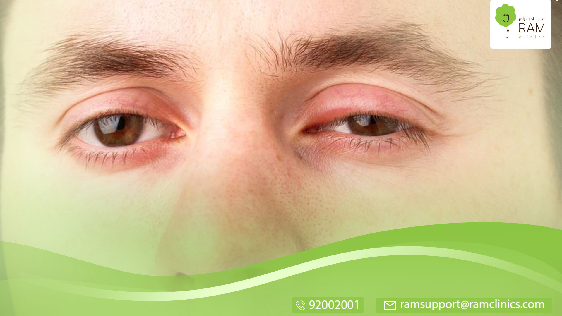 علاج انتفاخ جفن العين العلوي