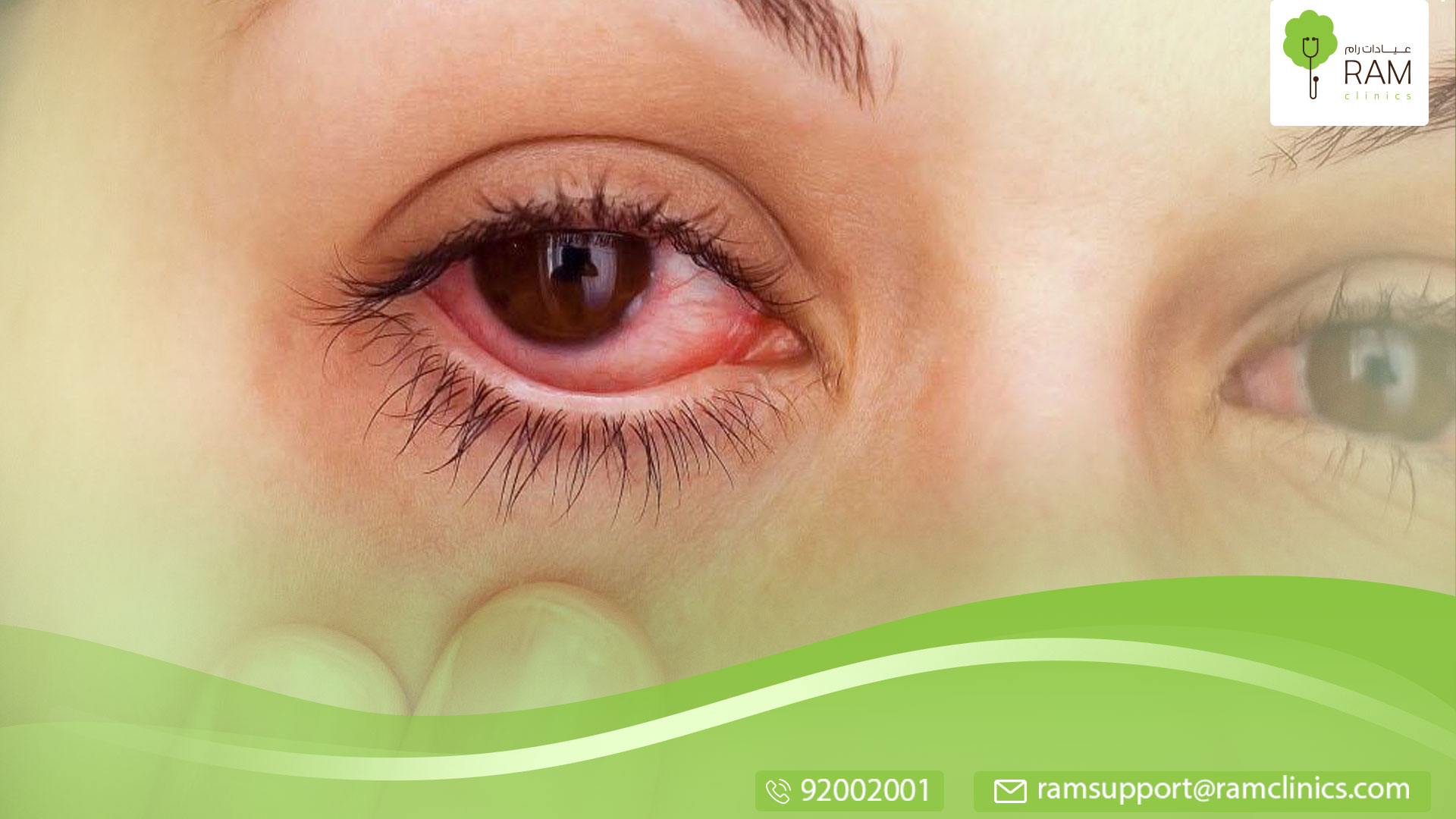 علاج حروق العين