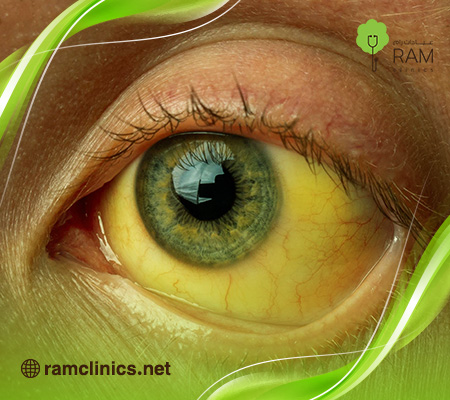 مرض-صفار-اليرقان