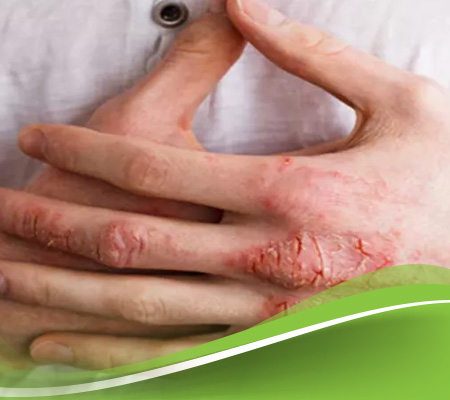 الاكزيما مرض معدي