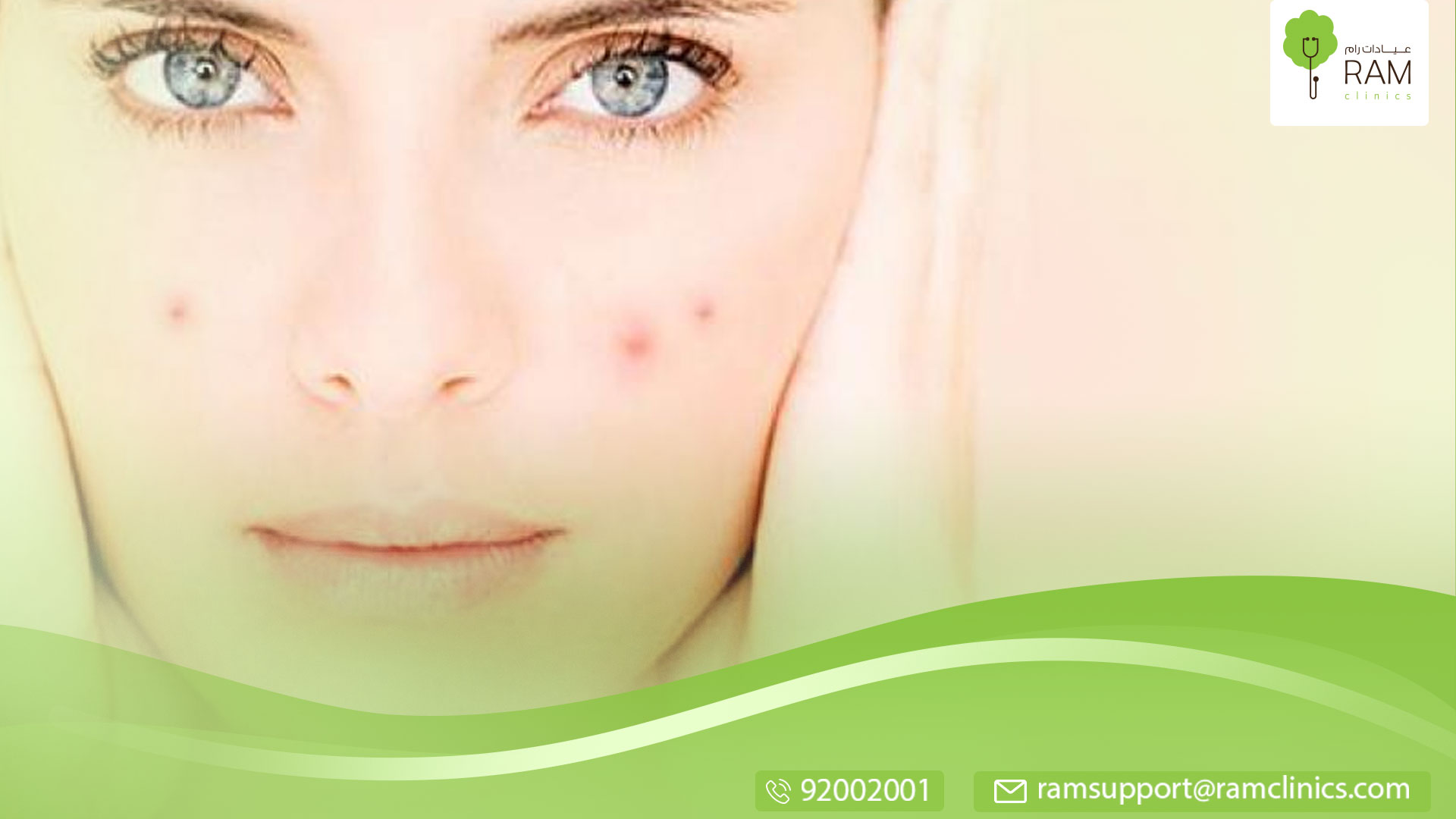 علاج حب الشباب