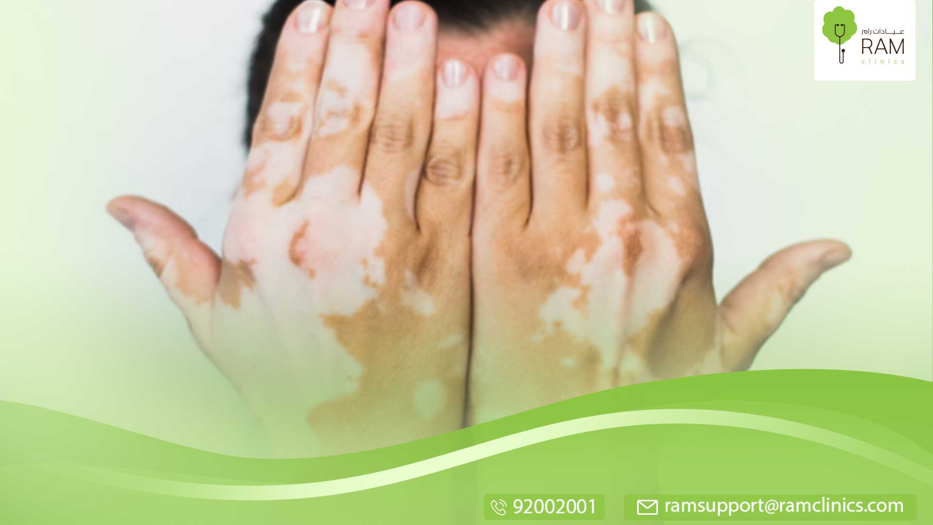 الفرق بين البهاق والبرص