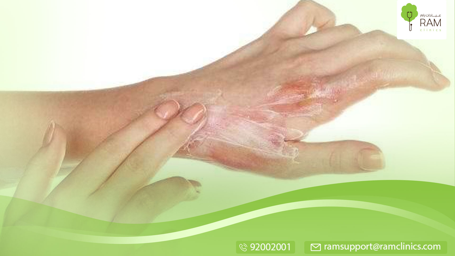 علاج آثار الحروق عند الأطفال نهائياعل