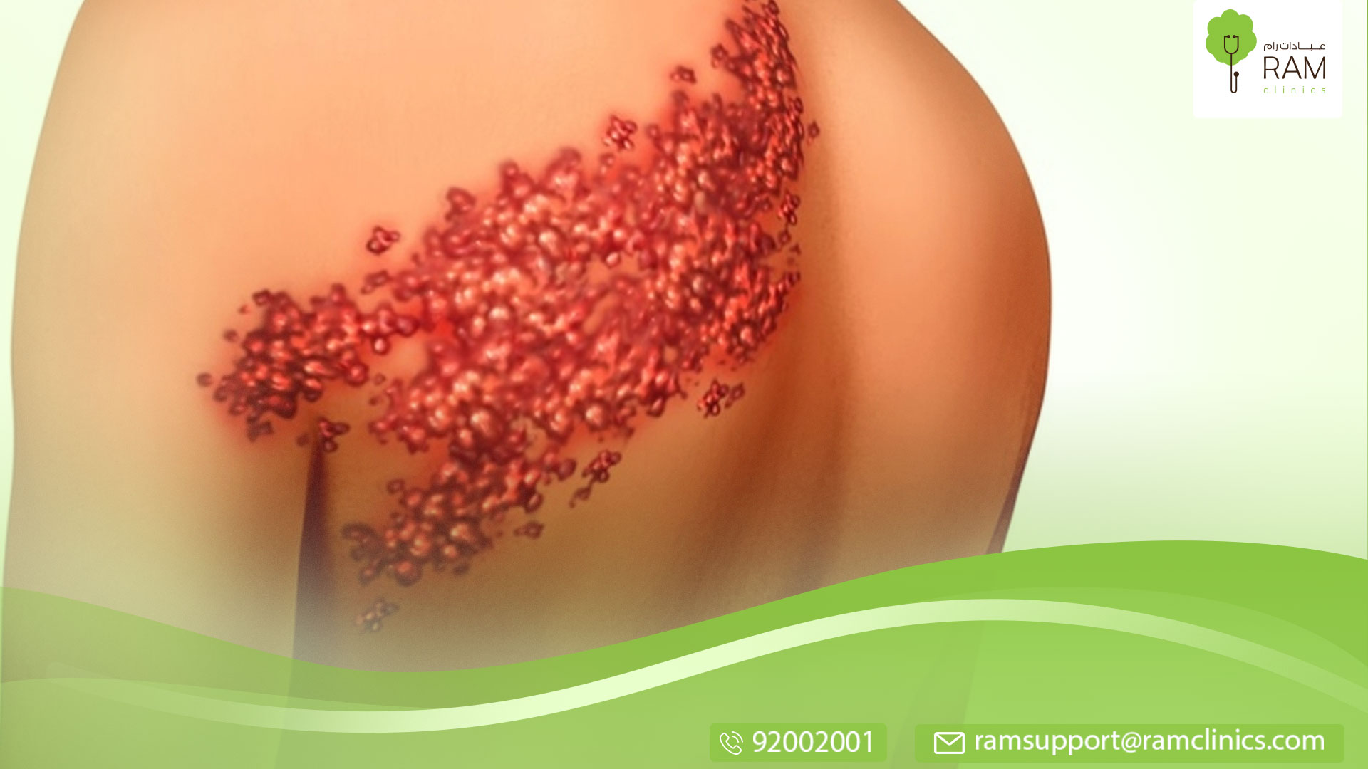 مضاعفات الحزام الناري