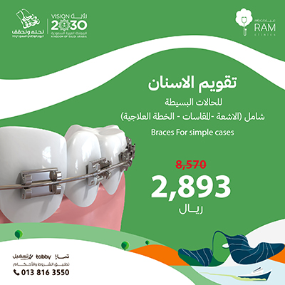 تقويم الاسنان