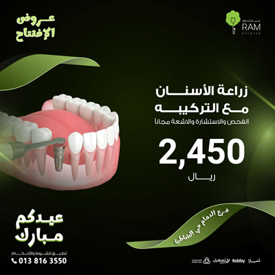 Dental implants with composition