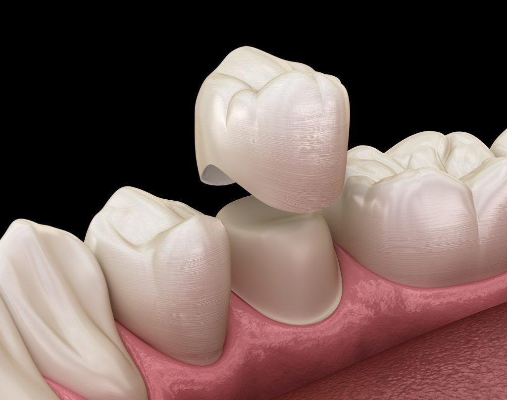 تركيبات ثابتة و متحركة للأسنان